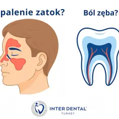 Zapalenie zatok czy ból zęba? Ilustracja pokazuje profil twarzy z zaznaczonymi zatokami oraz przekrój zęba. Dowiedz się, co zrobić na ból zęba.