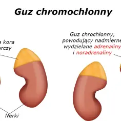 Guz nadnercza do jakiego lekarza? Kluczowe informacje o specjalistach