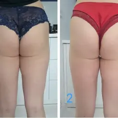Porównanie ud przed i po zabiegu. Widoczne wygładzenie skóry i poprawa sylwetki – to endermologia efekty.