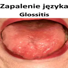 Zapalenie języka (glossitis) objawia się zaczerwienieniem i obrzękiem. Szukasz leki bez recepty na tę dolegliwość?