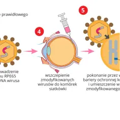 Schemat przedstawia terapię genową: wirus jako wektor biologia wprowadza prawidłowy gen RPE65 do komórek siatkówki, zastępując uszkodzony.