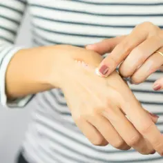 Dłoń z widoczną blizną, na którą aplikowana jest maść. Widoczna ziarnina w procesie gojenia.