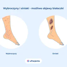 Wybroczyny i siniaki na nogach mogą być objawem ostrej białaczki szpikowej. Ilustracja pokazuje nogę z licznymi czerwonymi plamkami (wybroczyny) i nogę z dużymi, ciemnymi siniakami.