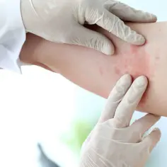 Alergia na chemikalia objawy: poznaj niebezpieczne reakcje i objawy