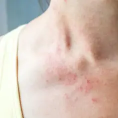 Skuteczne metody leczenia zapalenia mieszka włosowego i ich ryzyka