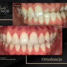 Aparat estetyczny przed i po: krzywe zęby wyprostowane. Efekt ortodoncji w Dental Avenue.
