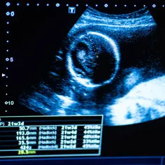 USG płodu z danymi: wielkość pęcherzyka ciążowego tabela, wiek ciążowy 21w3d, wymiary BPD, HC, AC, FL, EFW, Dist A.