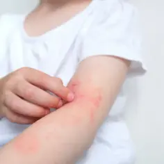 Dziecko z egzemą na ramieniu, które swędzi. Może to być reakcja alergiczna, np. na pokarm, jak Nutramil.