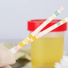 Rękawiczka trzyma paski testowe do analizy moczu, które mogą wykryć m.in. podwyższony mocznik we krwi. W tle pojemnik z żółtym płynem.