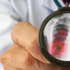 Jakie leki chemioterapeutyczne są najskuteczniejsze w raku płuc?