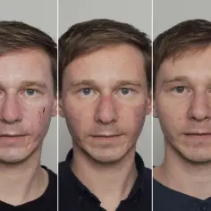 Jak wygląda twarz po laserze frakcyjnym? Efekty, które zaskakują
