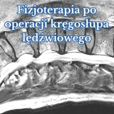 Czy fizjoterapia pomaga na kręgosłup? Odkryj skuteczne metody leczenia