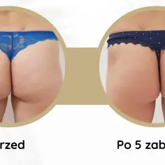 Porównanie pośladków przed i po 5 zabiegach endermologii. Widoczna poprawa jędrności i wygładzenie skóry.