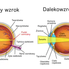 Porównanie oka z prawidłowym widzeniem i oka z nadwzrocznością. Promienie światła skupiają się za siatkówką.