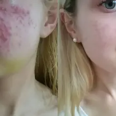 Przed i po kuracji trądziku. Zmiana skóry po zastosowaniu leczenia. Warto sprawdzić izotek cena.