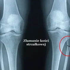 Skuteczne metody na ból po złamaniu – ulga i szybkie leczenie