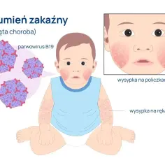 Rumień zakaźny - poznaj wszystkie drogi zakażenia i skuteczną profilaktykę