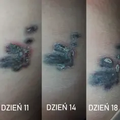 Czy antybiotyk po tatuażu szkodzi? Wszystko o bezpieczeństwie i gojeniu