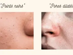 Gros plan sur la peau : points noirs d'un côté, et de l'autre, une zone avec des pores dilatés, suggérant un traitement.
