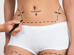 Rysowanie linii na brzuchu i udach. Zastanawiasz się, ile kosztuje zabieg liposukcji?