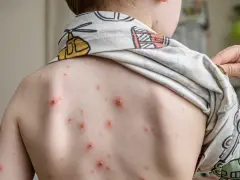 Plecy dziecka pokryte licznymi, czerwonymi krostami, świadczącymi o ospie.