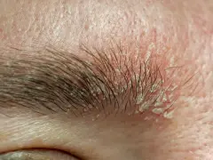 Nahaufnahme einer geröteten Haut mit schuppigem Ausschlag im Bereich der Augenbrauen, der auf einen Ausschlag auf der Kopfhaut hindeutet.