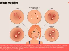 Ilustracja przedstawia różne rodzaje trądziku: grudki, zaskórniki, krosty, guzki i torbiele.