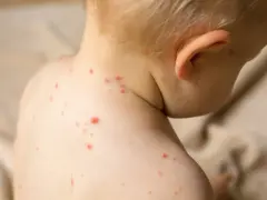 Skóra dziecka pokryta czerwonymi kropkami, objawami choroby, takiej jak odra.