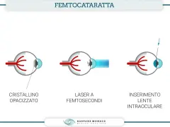 Chirurgia della cataratta con laser: illustra cristallino opacizzato, laser a femtosecondi e inserimento lente intraoculare. Valutare sempre le controindicazioni.