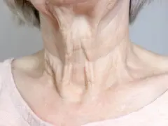 Primer plano del cuello flácido de una mujer mayor, mostrando arrugas y pliegues pronunciados.