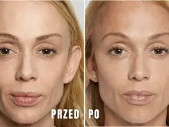 Modelowanie żuchwy przed i po. Porównanie twarzy kobiety przed i po zabiegu, ukazujące subtelne zmiany w linii żuchwy.
