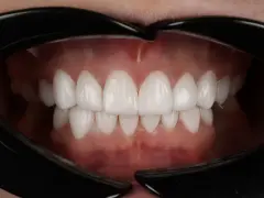 Piękne, białe zęby po zabiegu dental bonding. Uśmiech jak z reklamy!