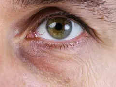 Eisenmangel symptome augen: Dunkle Augenringe und ihre Ursachen erkennen