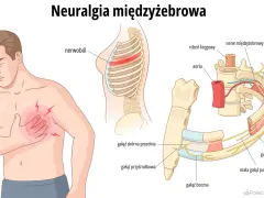 Ilustracja przedstawia mężczyznę z bólem w klatce piersiowej, wskazującym na neuralgię międzyżebrową. Widok anatomiczny ukazuje unerwienie żeber.