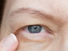 Zbliżenie na niebieskie oko, gdzie widoczna jest opadająca powieka w młodym wieku, delikatne zmarszczki i drobne włoski.