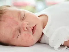 Alergia u niemowlaka objawy – jak je rozpoznać i co zrobić?
