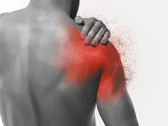 Ból barku, objaw capsulitis adhesiva, zaznaczony czerwienią.