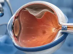 Dettaglio anatomico dell'occhio con il vitreo trasparente, pronto per un emovitreo intervento. Si intravede un microscopio chirurgico.