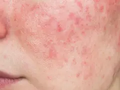 Primo piano del viso con evidenti rossori e imperfezioni cutanee, che suggeriscono una condizione come la rosacea o l'acne.