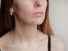 Primer plano de una joven con granos en la cara, mostrando la textura de su piel y algunas imperfecciones.