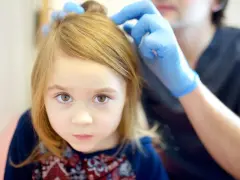 Lekarz w niebieskich rękawiczkach bada włosy dziewczynki, która może mieć łysienie plackowate u dzieci.