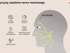 Ilustracja przedstawia przyczyny zapalenia nerwu twarzowego, w tym neuralgia nerwu trójdzielnego, choroby wirusowe, nowotwory, problemy stomatologiczne, zaburzenia naczyń mózgowych i zapalenie mięśni.