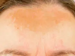 Nierównomierne plamy po solarium na czole, z zaczerwienieniami i przebarwieniami.