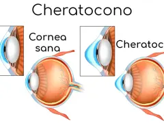Confronto tra cornea sana e cheratocono. Anche a 50 anni, il cheratocono può alterare la forma dell'occhio.