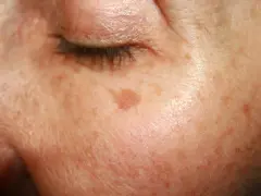 Haut mit Altersflecken. Ab wann diese auftreten, ist individuell. Hier eine Nahaufnahme der Haut mit Pigmentflecken.