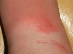 Pelle arrossata e infiammata sulla gamba, con segni di erisipela.
