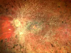 Retina con pigmentazione irregolare e vasi sanguigni, indicativa di amaurosi congenita di Leber. Ricerca di nuove cure in corso.