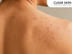 Close-up of shoulder acne. Learn how to get rid of shoulder acne overnight for clearer skin.