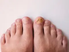 Gros plan sur des pieds, dont un ongle d'orteil atteint d'une mycose, illustrant un problème d'entretien ongles pieds.