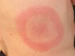 Hudutslag med rodnad och ringformad irritation, kan vara relaterat till klåda på kroppen klimakteriet.